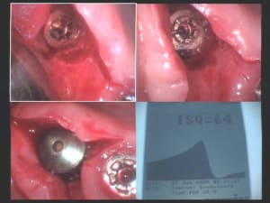 Un cas difficile réouverture implants 16 et 17 iii uxokfe - Eugenol