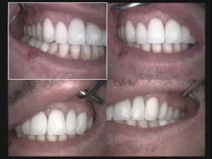Un vingtaine de procera f5wycc - Eugenol