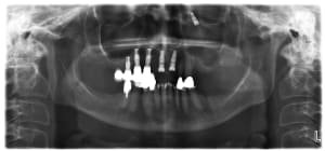 Xximplant kiqnyk - Eugenol