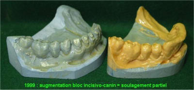 04 edentement unilateral lp2qzb - Eugenol