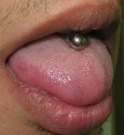 051018 piercinglg ylftuf - Eugenol