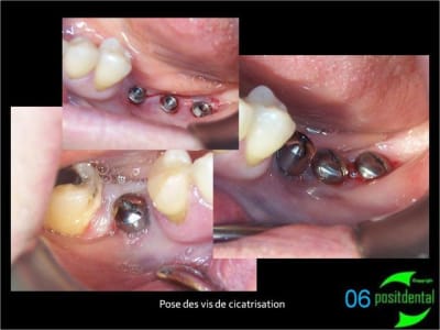 06 positdental guide chirurgical juxta muqueux   appuis dentaires n2bdzb - Eugenol