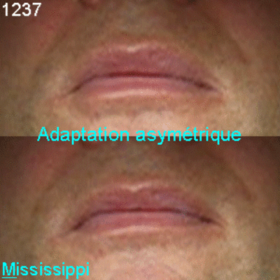 06 asymétrie adaptation sio2n0 - Eugenol