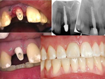11 immidiat implantation yhfyd0 - Eugenol