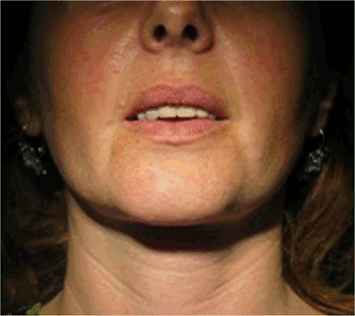 11 post traitement cpynem - Eugenol