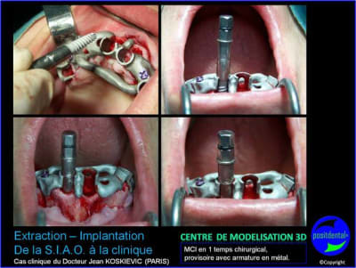 12 extraction mci bridge provisoire avec armature m tal qcupxd - Eugenol