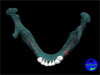13 positdental mod lisation 3d lnybhe - Eugenol