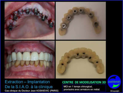 14 extraction mci bridge provisoire avec armature m tal trmhis - Eugenol