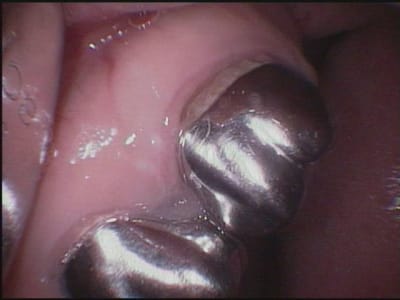 16 17 avant traitement gazmww - Eugenol
