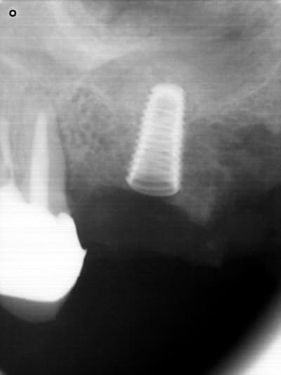 16 implant dentium 24 02 09 bt0f3y - Eugenol