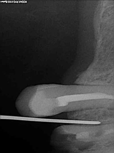 1 periotome kerkcw - Eugenol