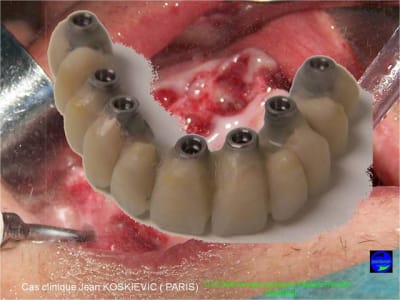 23 extraction mci bridge provisoire avec armature m tal smd3xh - Eugenol