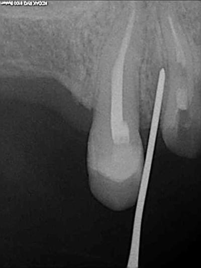 2 periotome nm2c7e - Eugenol
