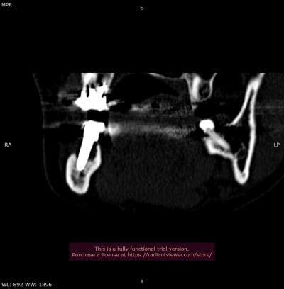 3d mpr 03 08 2020 17 05 09   mandibule 0000 qhicy2 - Eugenol