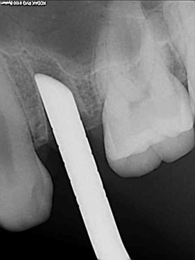 3 fracture corticale sinusale gacfu5 - Eugenol