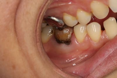 46 avant  claircissement ondqvo - Eugenol