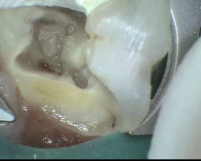 4 photo mise en evidence canaux mesiaux zqygeg - Eugenol