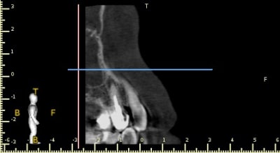 5 paa0 sagittal view lhrm1b - Eugenol