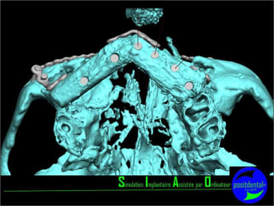 Aa simulation implantaire assist e par ordinateur 006 obfvu8 - Eugenol