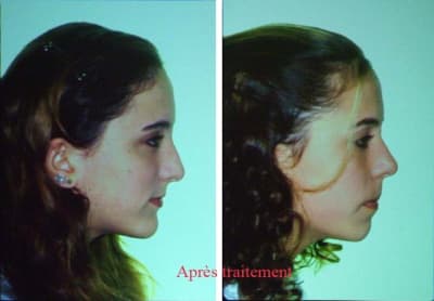 Apr s traitement 2 z0fdox - Eugenol