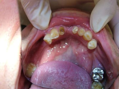 Bas faces occlusales 1 cdbbud - Eugenol