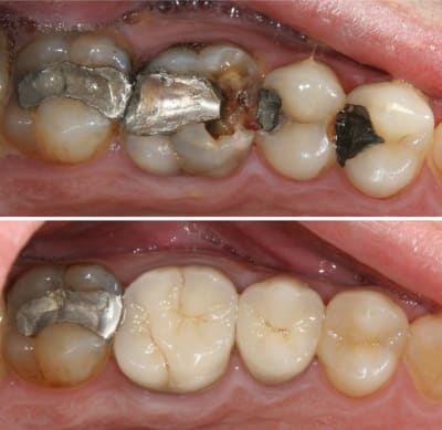 Beforeafter udolki - Eugenol