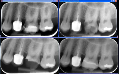 Biodentineremontedemargeonlay ltoomd - Eugenol