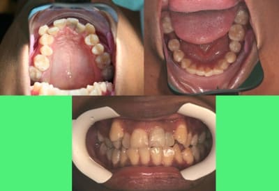Bouche 1 zehenf - Eugenol