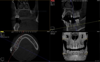 Cbct vlvefj - Eugenol