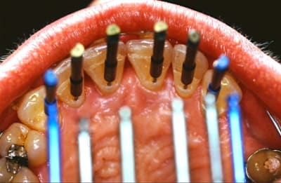 Contention  - Eugenol