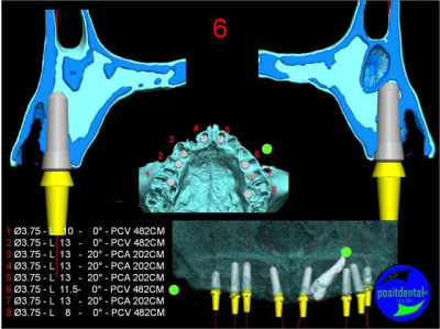 Canine incluse 4 dnnf3v - Eugenol