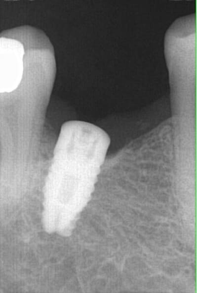 Capture implant yxprhv - Eugenol