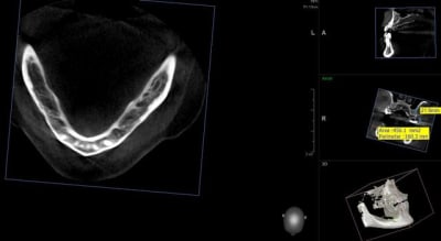 Capture vatech s6ple1 - Eugenol