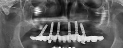 Captureimplant wwa9la - Eugenol