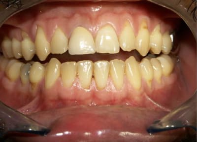 Cas 3 a mascgd - Eugenol