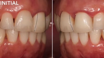 Centrale unitaire zircone translucide ht ceramique feldspathique noritake chappe anatomique transparence mimetisme - Eugenol