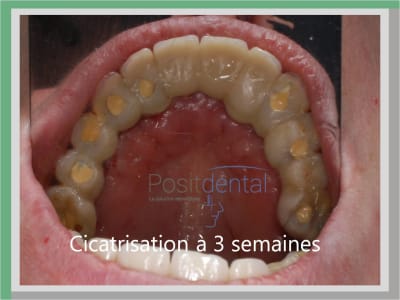 Cicatrisation à 3 semaines 02 fh6n65 - Eugenol