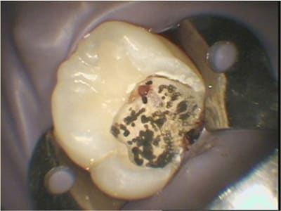 Coiffage pulpaire - Eugenol