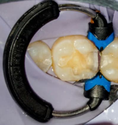 Composi tight 3d xr - Eugenol