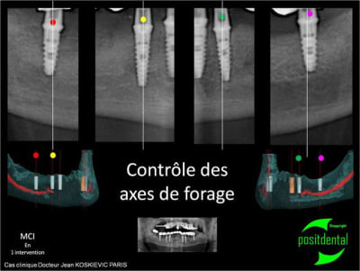 Contr le des axes de forage - Eugenol