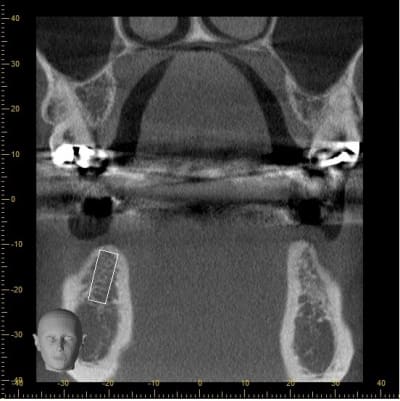 Coupe 4 implant 46 hjc8ip - Eugenol