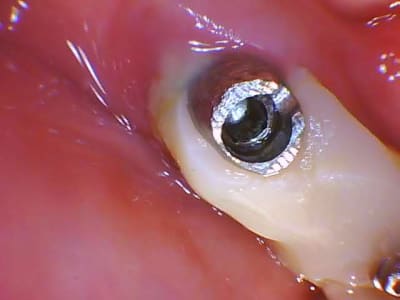 Demo patient3 2020 03 12 185120 sphcso - Eugenol