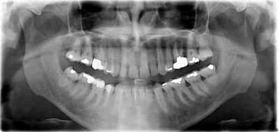 Diastemes vfsdjp - Eugenol