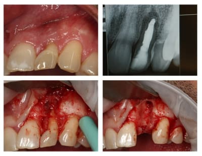 Dent 22 rog kvhcsa - Eugenol