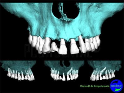 Eimci et canine incluse positdental 02 jv38pi - Eugenol