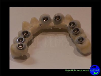 Eimci et canine incluse positdental 11 z4l02m - Eugenol