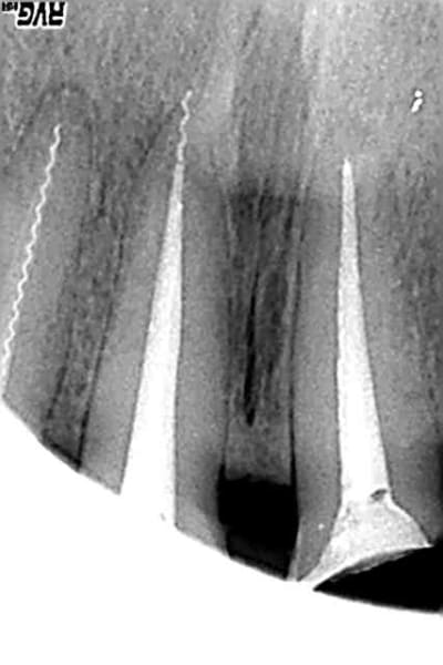 Endo1 bis ghcchp - Eugenol