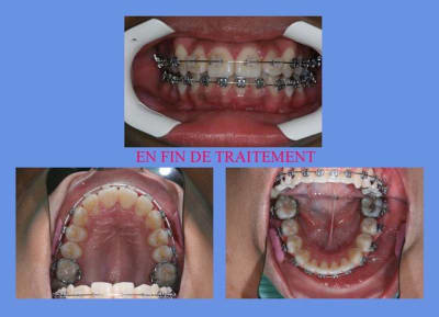 En fin de traitement fdnw1y - Eugenol