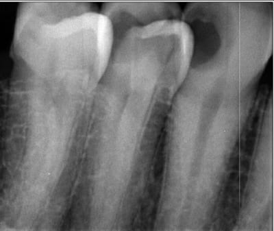 Endo 22 23  1  preop fvwsud - Eugenol
