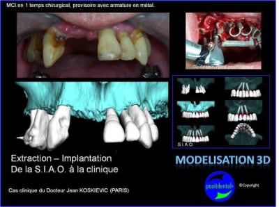 Extraction   implantation   mod lisation 3d positdental  5 l96gpf - Eugenol